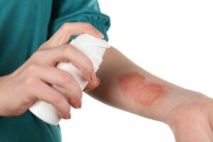 How To Treat Burn Injuries?