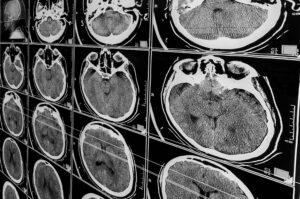 los angeles brain injury lawyer